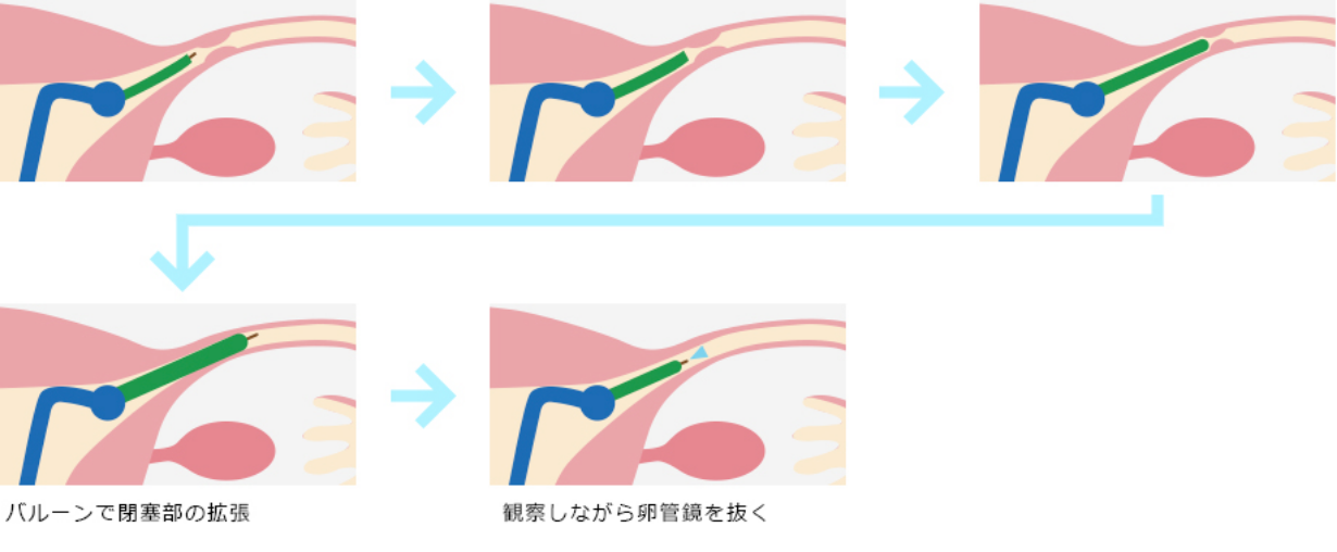 卵管鏡下卵管形成術(FT)