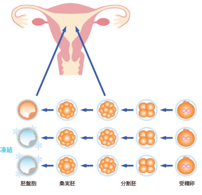 ⾃然周期下凍結胚移植