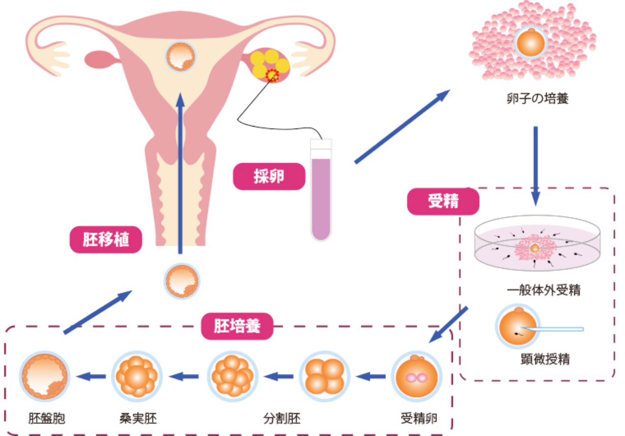 体外受精